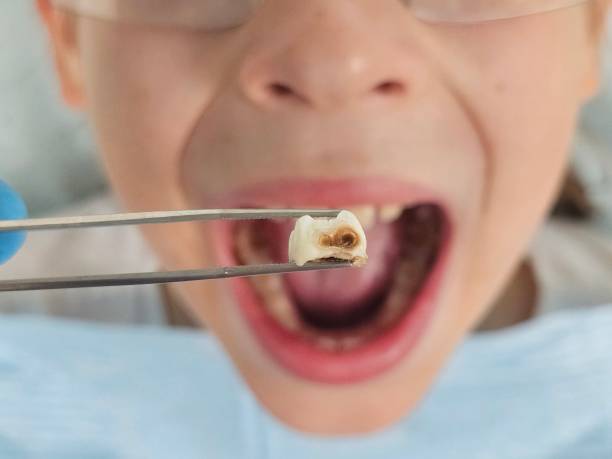 Best Emergency Denture Repair in Burtonsville, MD